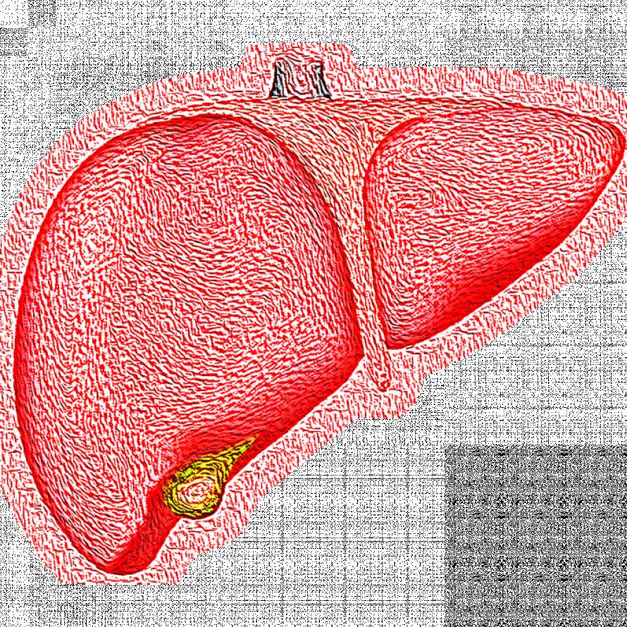 Можно вылечить цирроз печени на начальной стадии. Гепатитный цирроз печени. Телеангиоэктазии цирроз. Многоузловой цирроз печени.