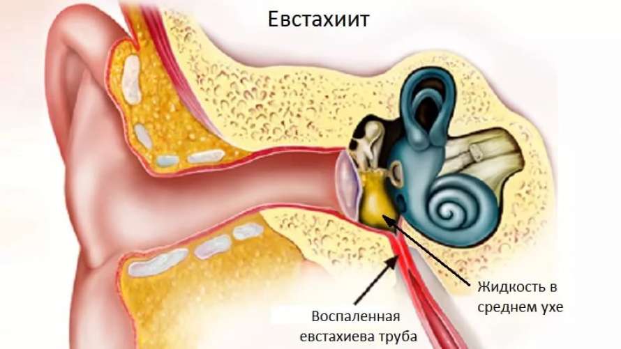 Заложенность уха водой